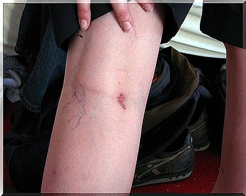 Curiosities about varicose veins that you should know