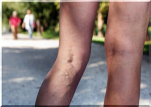 Suffering-from-varicose-veins