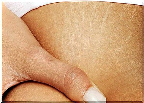 Stretch marks on the woman's body.