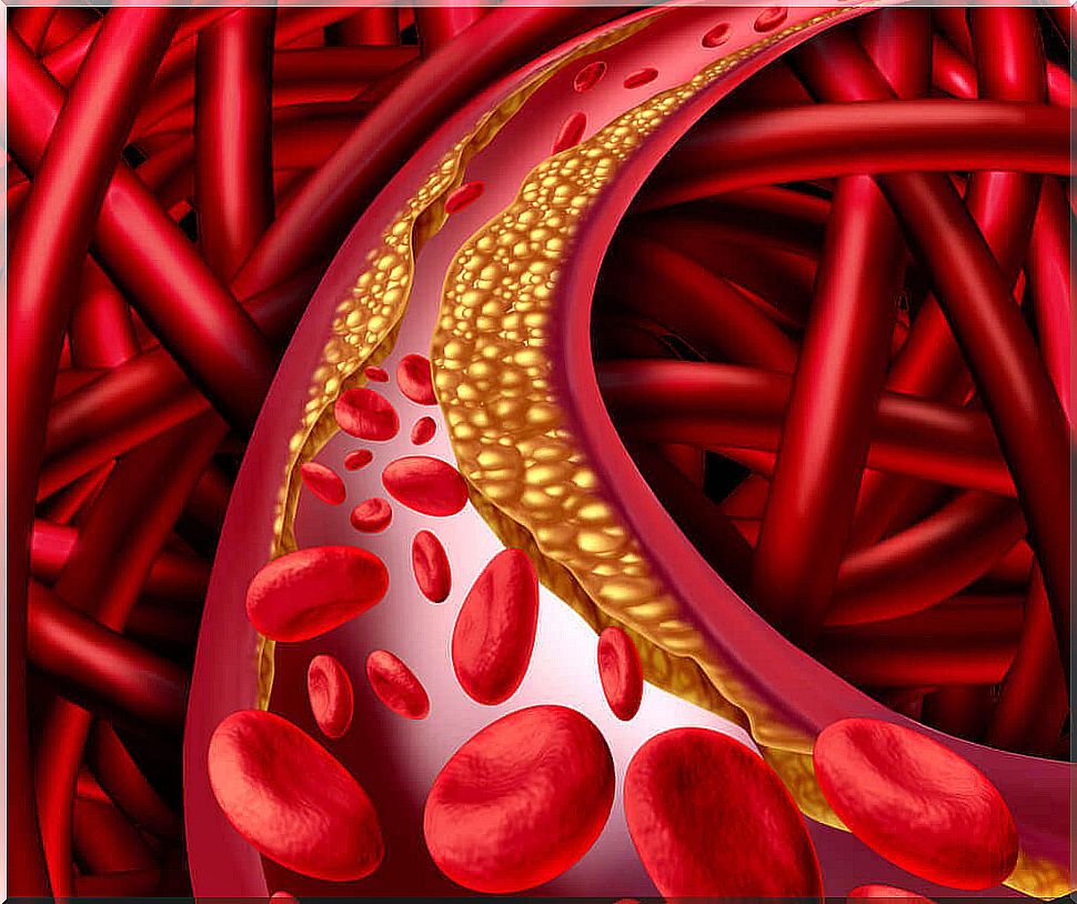 Artery with high cholesterol levels