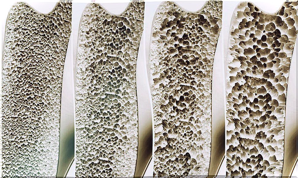 Bones with osteoporosis