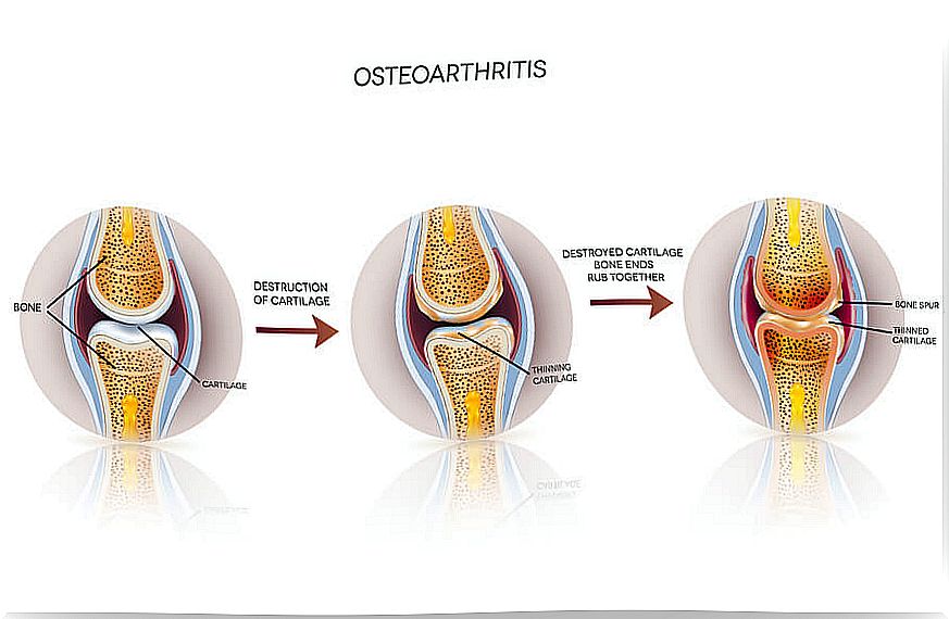 Stages of osteoarthritis.