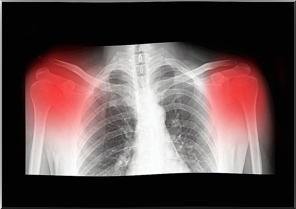 X-ray of shoulders with osteoarthritis.