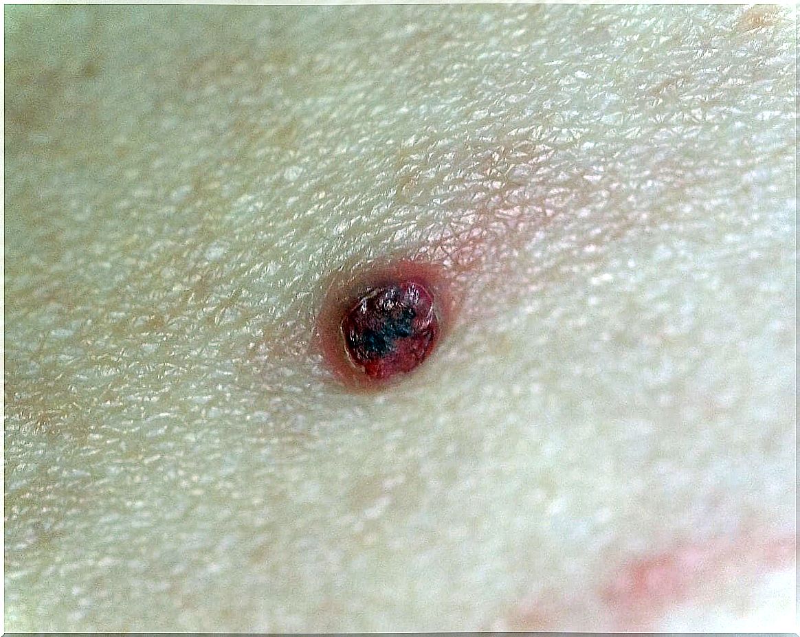 Pyogenic granuloma